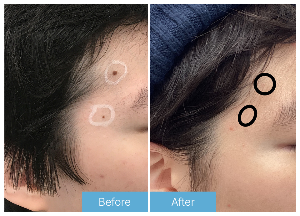 Mole removal
