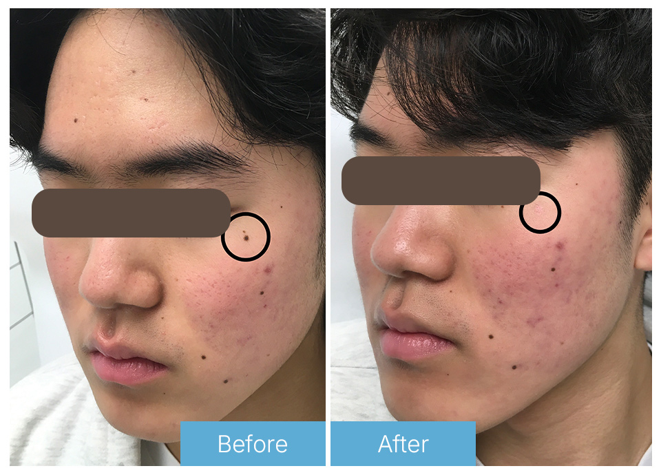 Mole removal