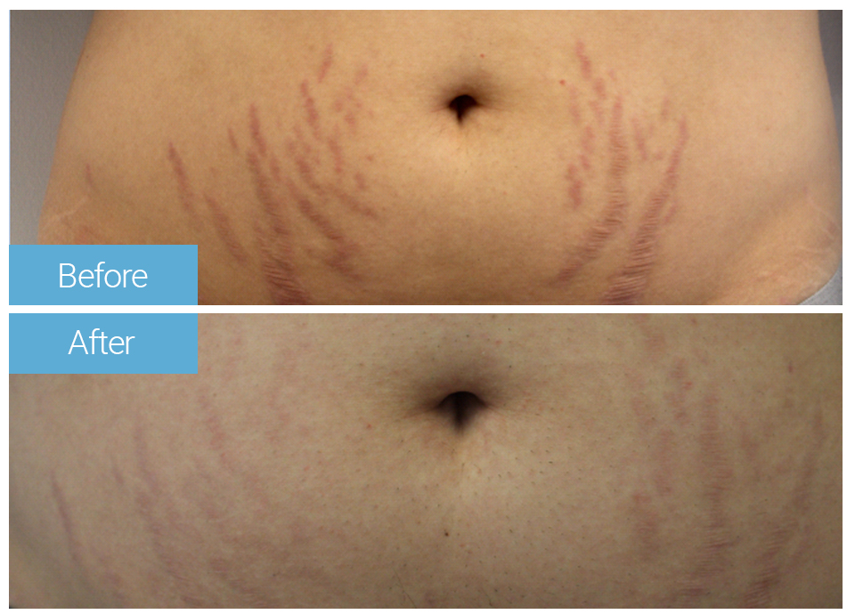 Stretch Marks 