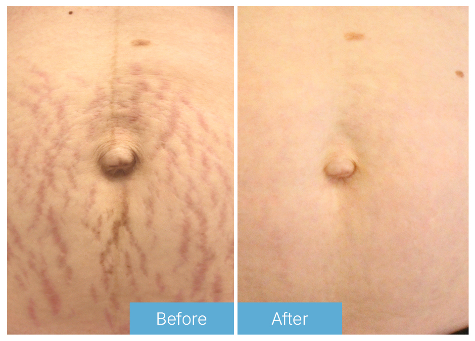 Stretch Marks 