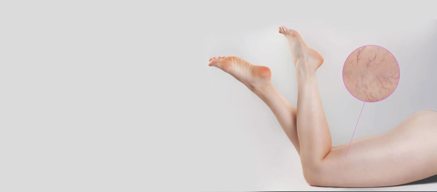 How to Prepare for Sclerotherapy – Before and After Care