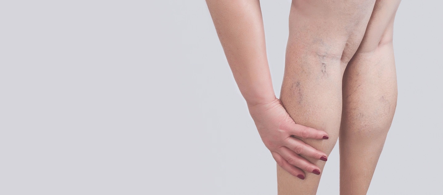 What You Should Know About Compression Stockings and Varicose Veins