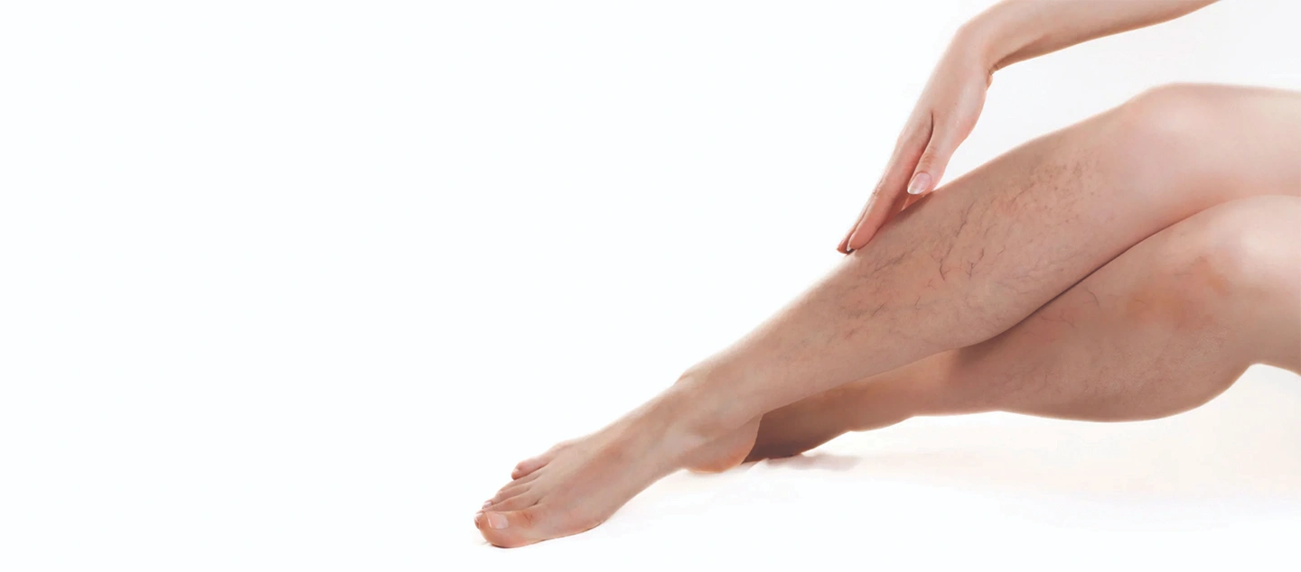 Do Varicose Veins Hurt?