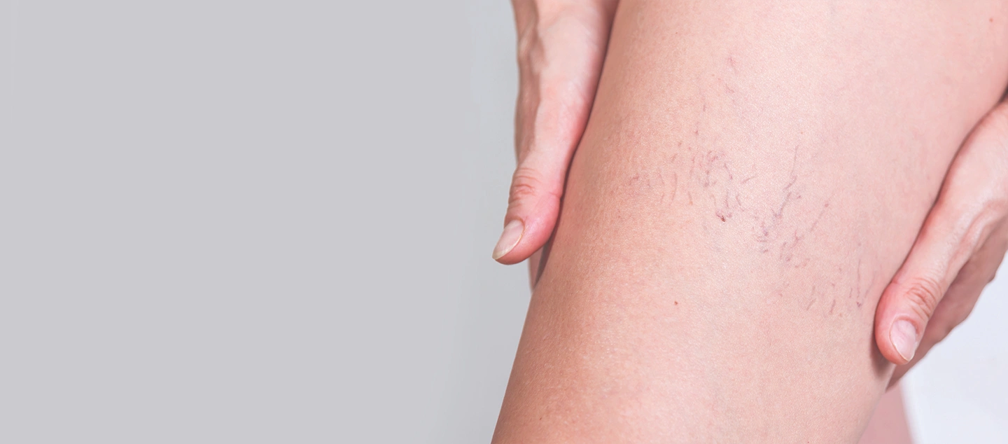 Can You Tattoo Over Varicose Veins?