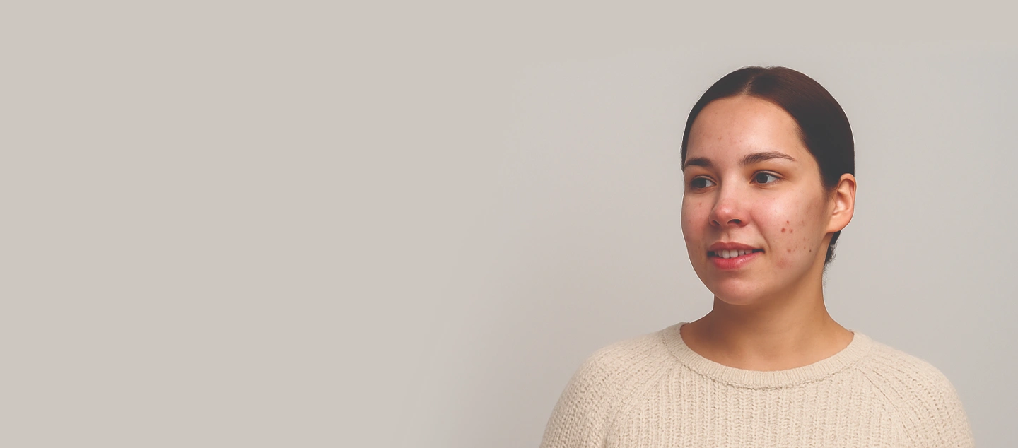 Best Way to Treat Rosacea