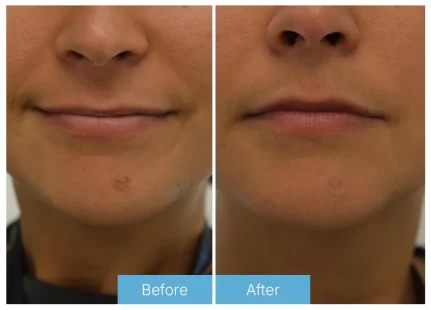 Fractional skin resurfacing