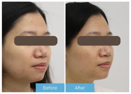 Fractional skin resurfacing