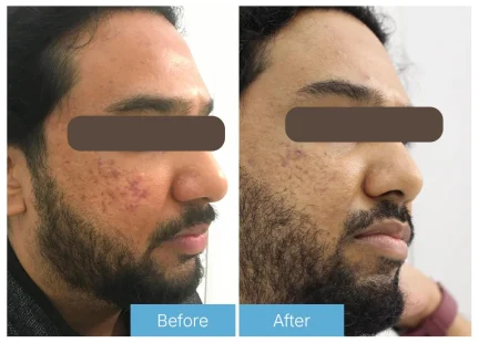 Fractional skin resurfacing