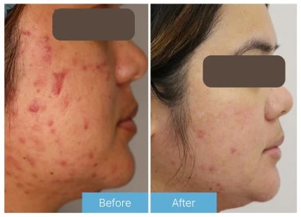 Laser acne Chemical peels