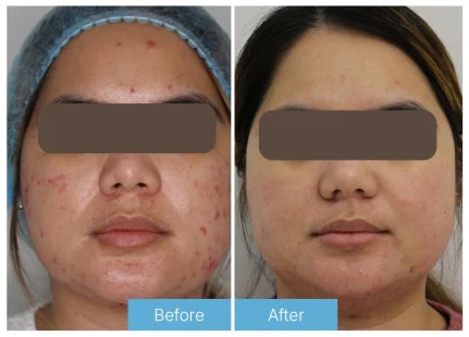 Laser acne Chemical peels