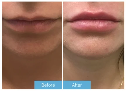 Lip fillers