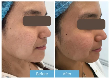 Microneedling
