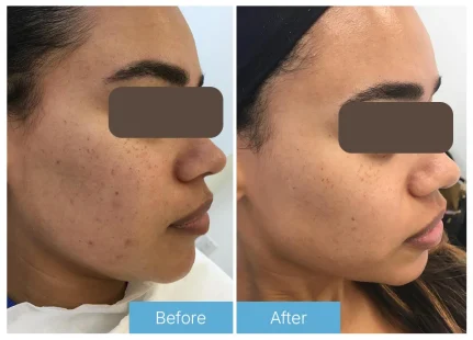 Microneedling