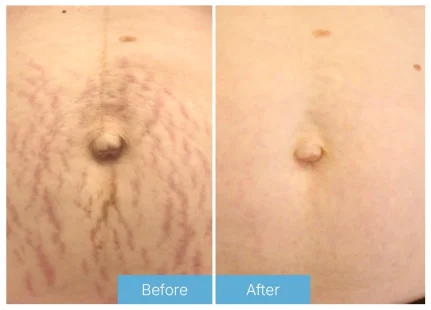 Stretch Marks 